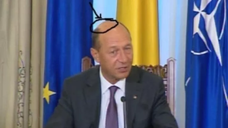 Basescu are 3 pete pe cap: Arsuri de soare, imbatranire sau cancer?