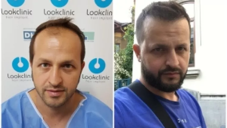 Cum arata actorul Razvan Oprea, la zece luni de la implantul de par!