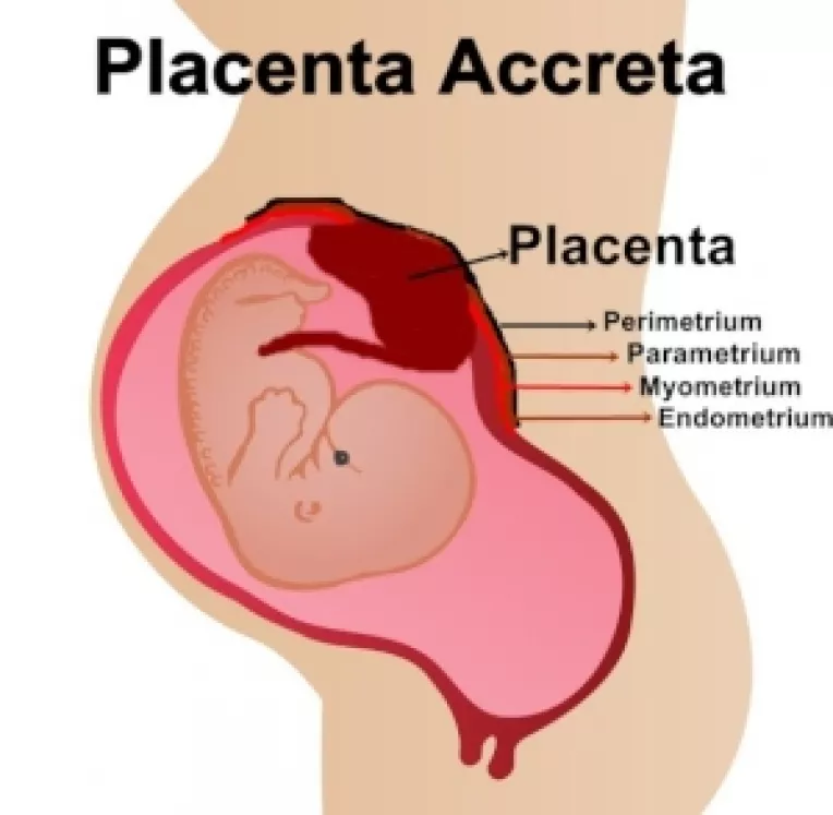 Placentografia: Riscurile la care se expun femeile care-si mananca placenta dupa nastere