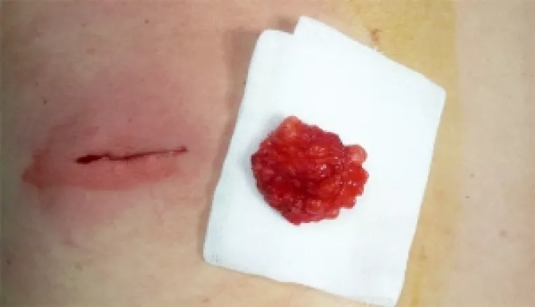 Tratamente naturiste in cazul lipoamelor