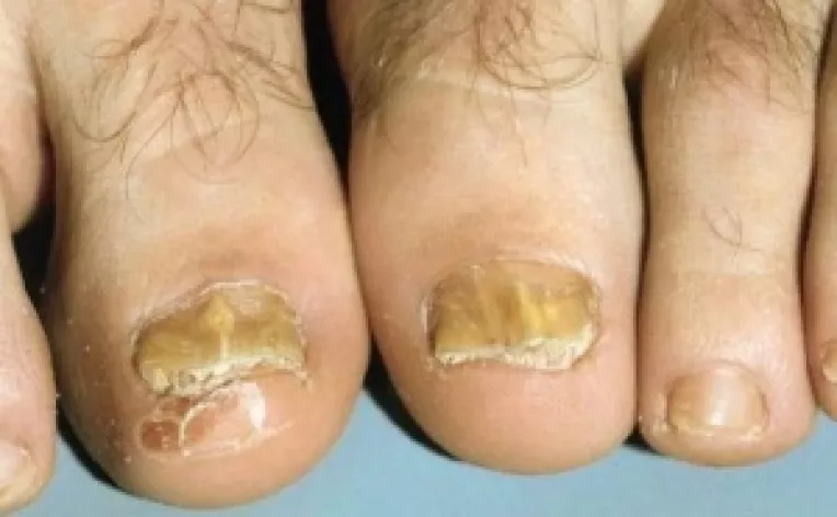 Tratamentul onicomicozei nu este decontat de Casa Nationala de Asigurari de Sanatate